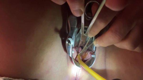 Tenaculum Grasping Cervix For Catheter 7 Min - hclips.com on pornsfind.com